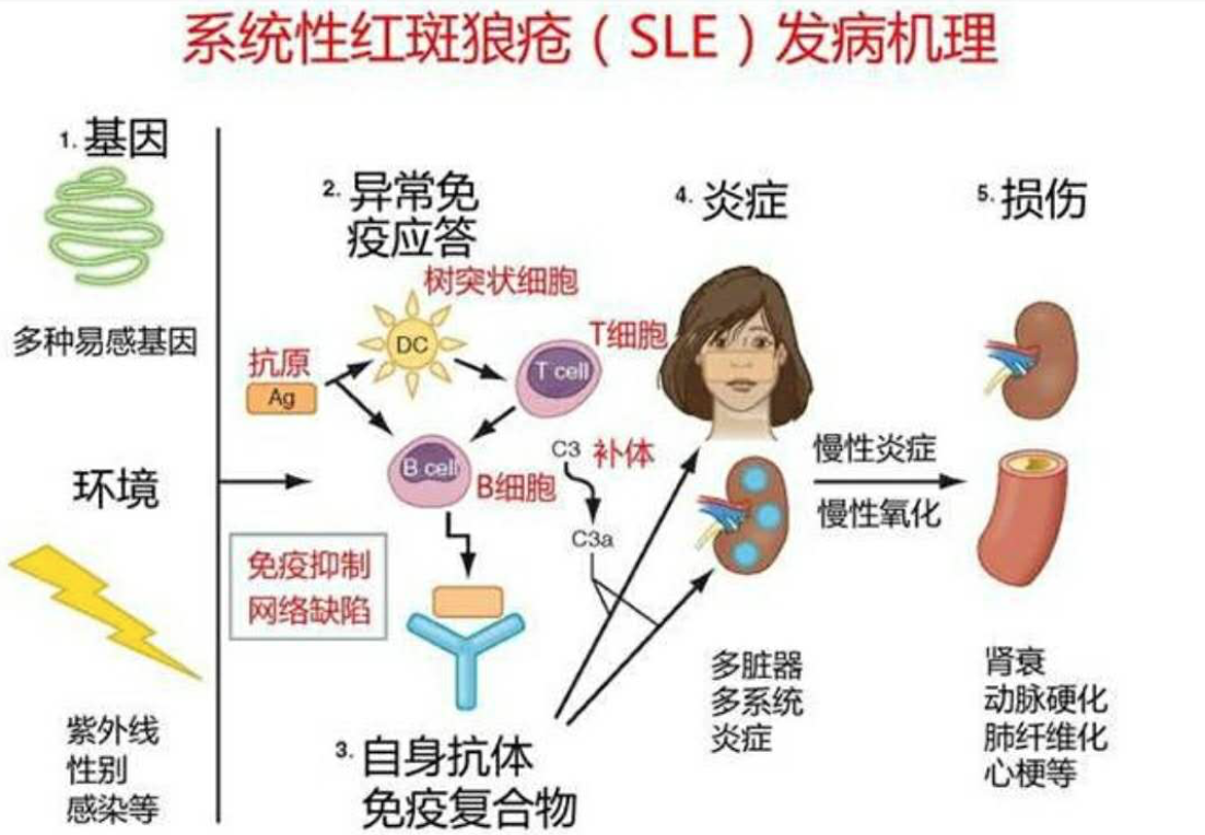 福田区风湿病专科医院为系统性红斑狼疮提供新的诊断及治疗思路